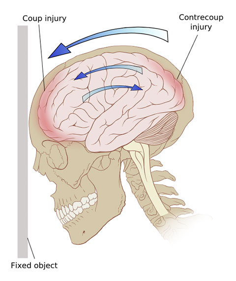 diffuse axonal injury mechanism